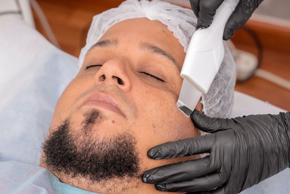 chemical peel treatment